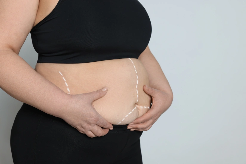Bariatric Weight Loss Surgery